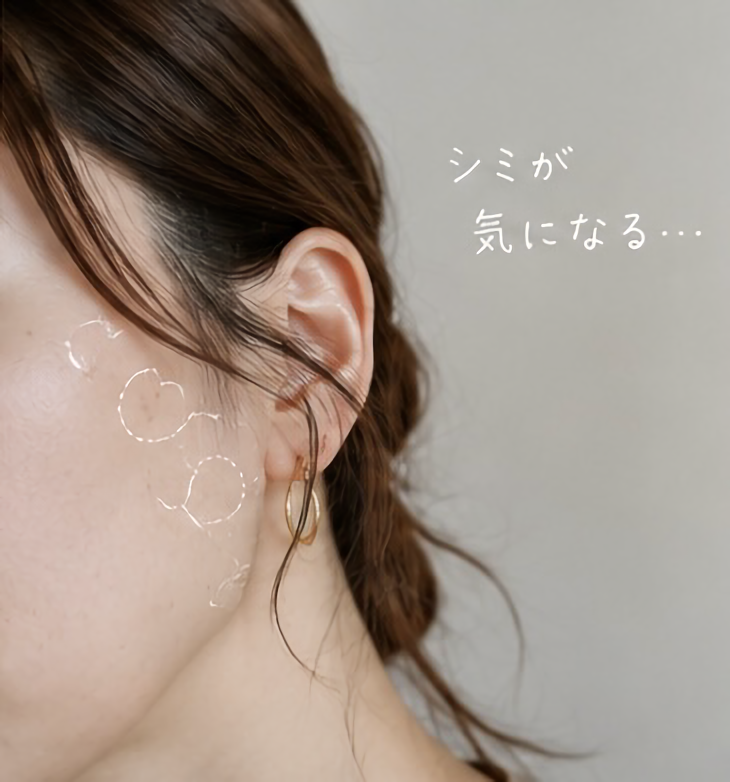 シミ取りレーザーのBefore/After（1ヶ月後）