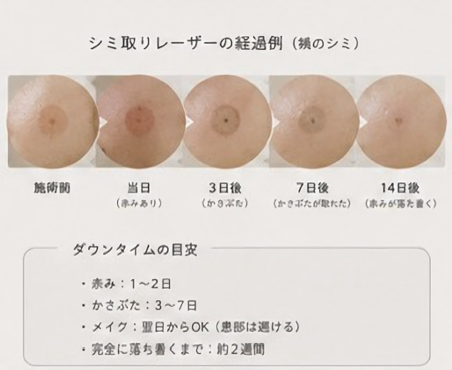 シミ取りレーザーの経過（施術前→当日→3日後→7日後→14日後）